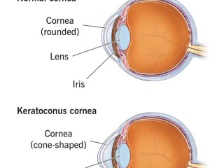 Keratoconus Treatment Specialist in Dubai Dr. Rahul Raghav