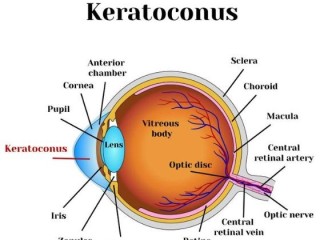 Dubai Keratoconus Treatment Specialist