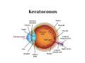 top-dubai-specialist-for-advanced-keratoconus-treatment-small-0