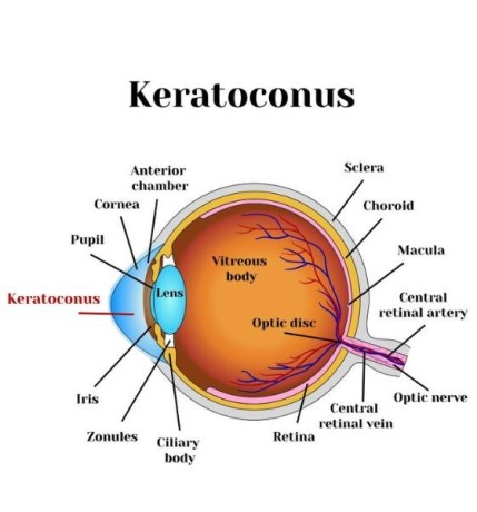 top-dubai-specialist-for-advanced-keratoconus-treatment-big-0