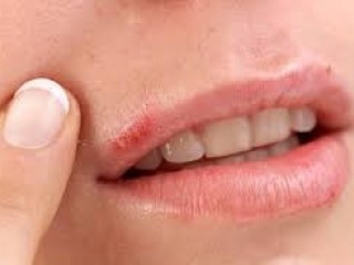 Mananging Herpes Symptoms:Acivir Cream