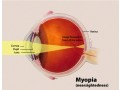 myopia-management-strategies-for-clearer-vision-small-0