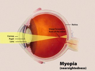 Myopia Management: Strategies for Clearer Vision