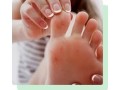 treatment-for-flat-feet-south-amboy-small-0