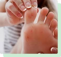 treatment-for-flat-feet-south-amboy-big-0