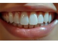 achieve-your-dream-smile-with-cosmetic-dentistry-lincoln-small-0