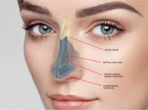 Nasal Valve Collapse and Surgical Solutions: What Patients Should Know