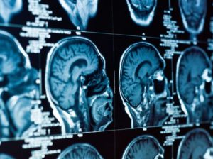 Neuro Oncology Surgery – Dr. Keval Shukla