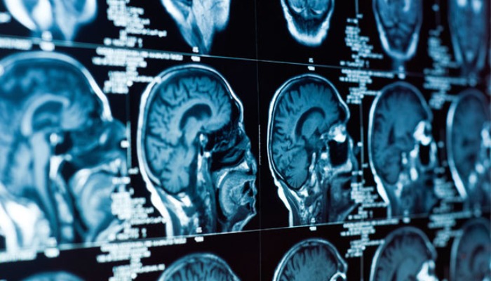 Neuro Oncology Surgery – Dr. Keval Shukla