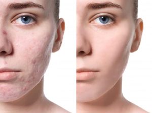 Is***There***a***Difference***Between***Acne***Scar***Treatments***in***Dubai***Clinics?