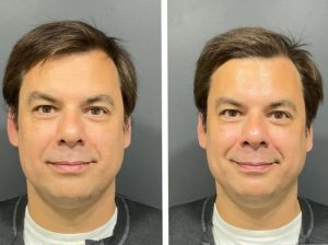 How***Often***Should***Men***With***Acne***Get***HydraFacial***in***Dubai?