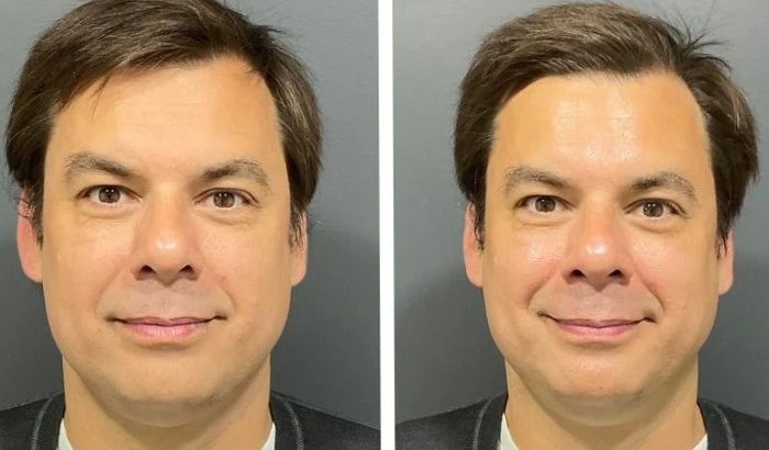 How***Often***Should***Men***With***Acne***Get***HydraFacial***in***Dubai?