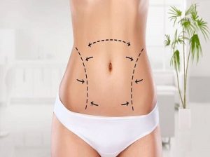 Can***Vaser***Liposuction***in***Dubai***Reduce***Fat***in***Hard-to-Treat***Areas***Like***Arms***or***Back?