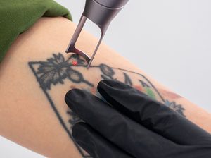Can***Laser***Tattoo***Removal***Darken***or***Lighten***the***Skin***Temporarily***in***Dubai?