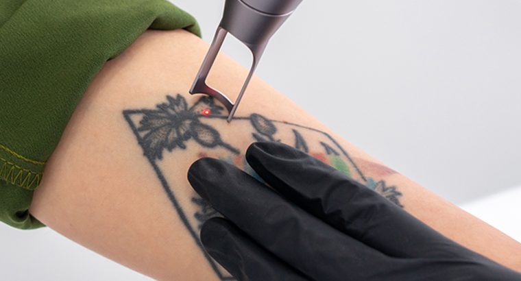 Can***Laser***Tattoo***Removal***Darken***or***Lighten***the***Skin***Temporarily***in***Dubai?
