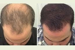 Can***Lifestyle***Habits***Affect***Hair***Transplant***Success***in***Dubai?