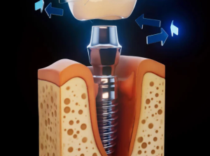 Dental***Implants***in***Englewood***for***missing***teeth