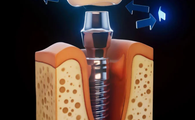 Dental***Implants***in***Englewood***for***missing***teeth