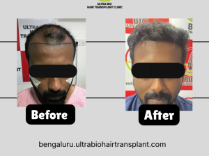 Hair***transplant***in***Bengaluru