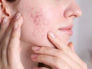 Can***Acne***Scar***Treatment***in***Dubai***Be***Combined***with***Other***Skin***Procedures?