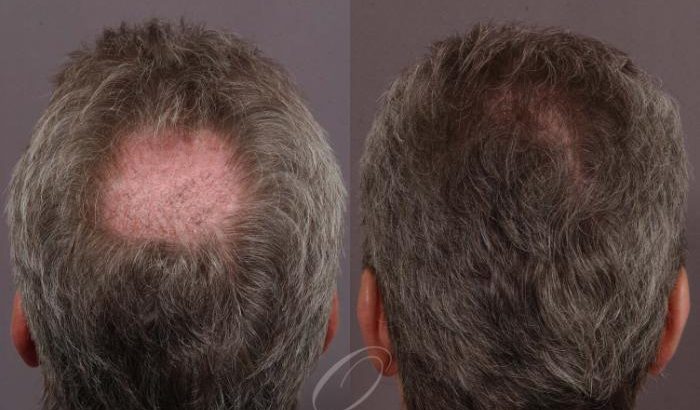 Is***Hair***Transplant***in***Dubai***Safe***for***People***with***Medical***Conditions?