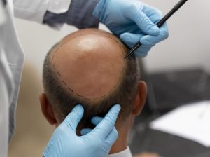 Are***follow-up***treatments***included***in***the***cost***of***hair***transplant***in***Dubai?