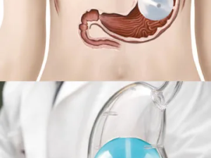 Can***a***gastric***balloon***help***reduce***waist***circumference***quickly***in***Dubai?