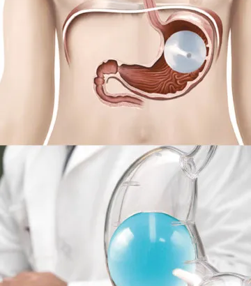 Can***a***gastric***balloon***help***reduce***waist***circumference***quickly***in***Dubai?