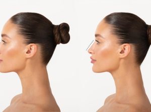 How***Much***Improvement***Can***I***Realistically***Expect***From***Rhinoplasty***in***Dubai?