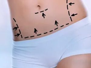 Are***non-surgical***fat***reduction***options***in***Dubai***better***than***liposuction?