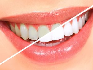 Professional***Teeth***Whitening***Services***in***North***Brunswick: Is***It***Worth***It?