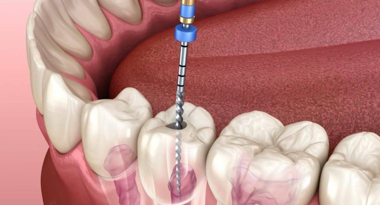 Signs***You***Need***Root***Canal***Treatment***In***North***Brunswick